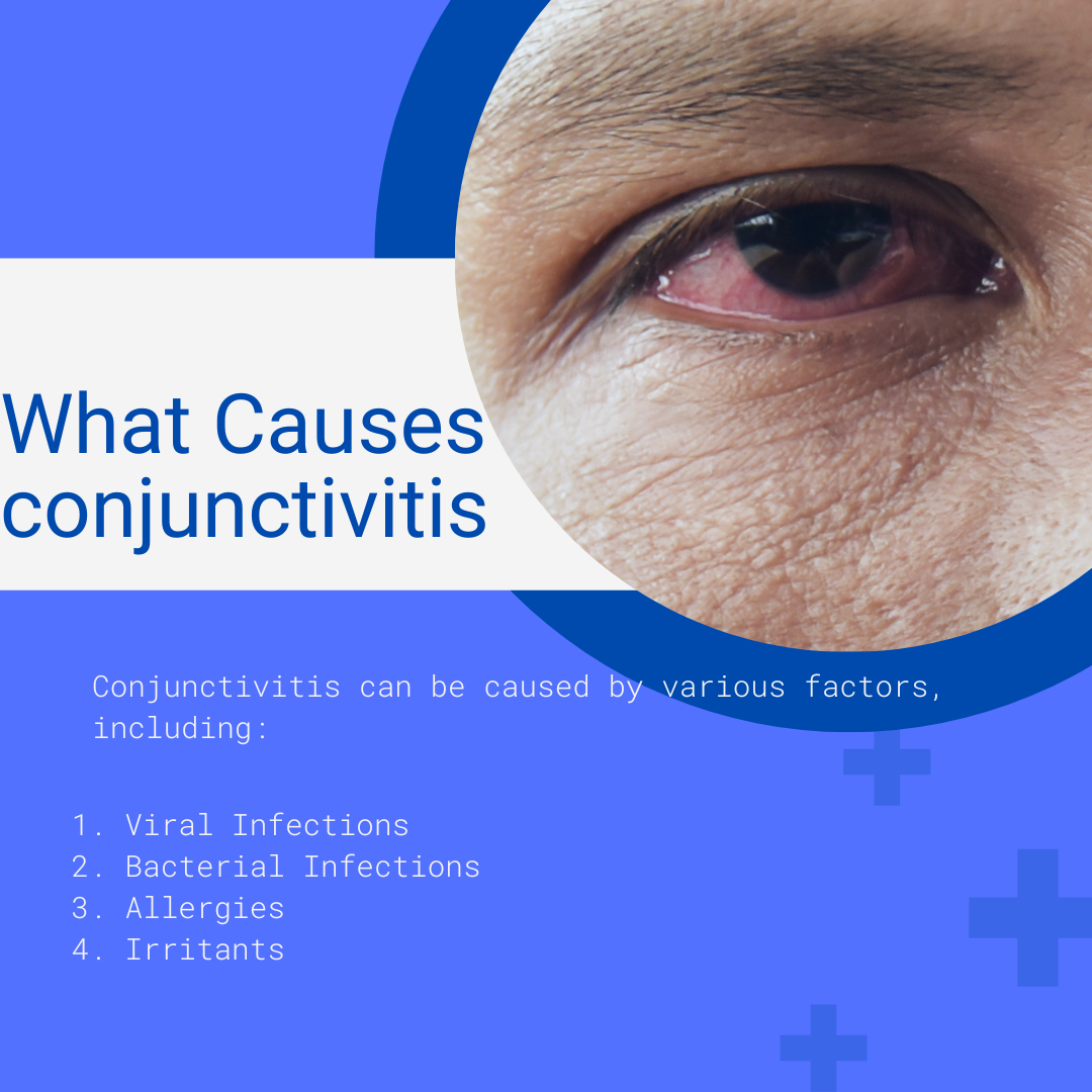 Conjunctivitis pink eye Understanding the Causes, Symptoms, and